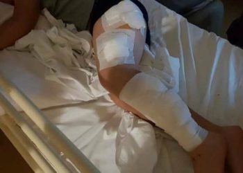 Εξιτήριο παίρνει ο 9χρονος μαθητής που δέχτηκε επίθεση από σκυλιά