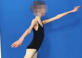Απίστευτο: 17χρονη μπαλαρίνα ζύγιζε 27 κιλά – Στη φυλακή οι γονείς της – ΒΙΝΤΕΟ