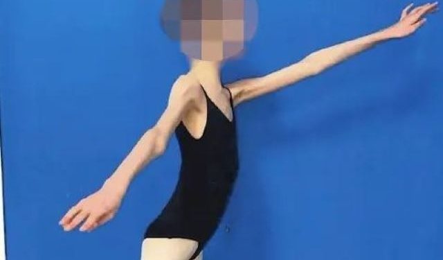 Απίστευτο: 17χρονη μπαλαρίνα ζύγιζε 27 κιλά – Στη φυλακή οι γονείς της – ΒΙΝΤΕΟ