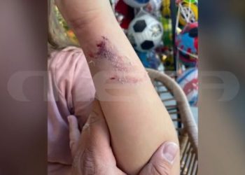 Άγρια επίθεση αδέσποτου σκύλου σε 11χρονη στην Πέλλα – ΦΩΤΟ