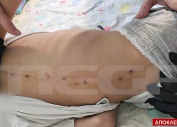 Θρίλερ με τα σημάδια στην πλάτη 7χρονου στην Πάτρα – ΒΙΝΤΕΟ – ΦΩΤΟ