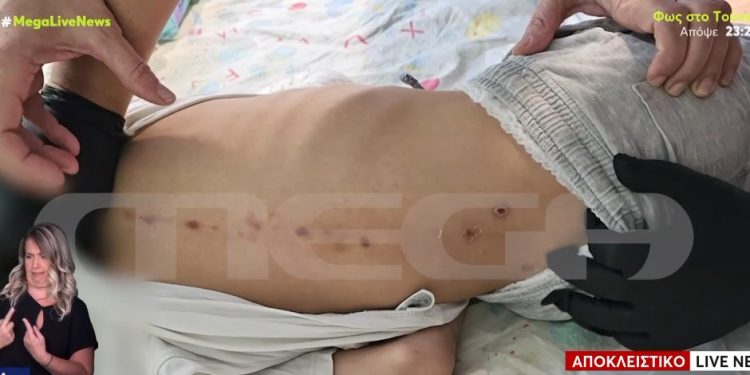 Θρίλερ με τα σημάδια στην πλάτη 7χρονου στην Πάτρα – ΒΙΝΤΕΟ – ΦΩΤΟ