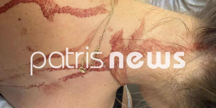 Πανικός στην Αμαλιάδα: Μαινόμενη γυναίκα κυνήγαγε μια άλλη στους δρόμους – Της επιτέθηκε με ψαλίδι – ΦΩΤΟ