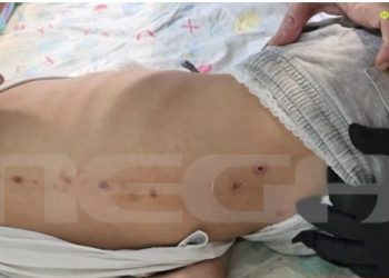 Πάτρα: Νέες μαρτυρίες για την υπόθεση του 10χρονου παιδιού με τα σημάδια στην πλάτη – ΒΙΝΤΕΟ – ΦΩΤΟ