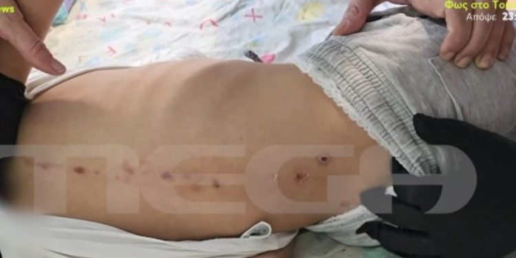 Πάτρα: Νέες μαρτυρίες για την υπόθεση του 10χρονου παιδιού με τα σημάδια στην πλάτη – ΒΙΝΤΕΟ – ΦΩΤΟ