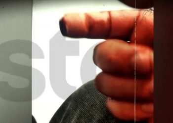 Απίστευτο: Τον δάγκωσε και του έκοψε το δάχτυλο για μια θέση πάρκινγκ στον Κορυδαλλό – ΦΩΤΟ