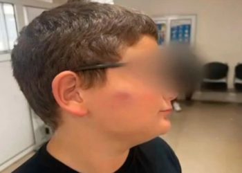 Θύμα bullying 11χρονος: Δέχθηκε επίθεση από συμμαθητές του στο σχολείο – ΒΙΝΤΕΟ – ΦΩΤΟ