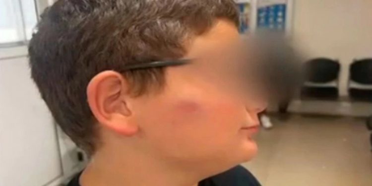 Θύμα bullying 11χρονος: Δέχθηκε επίθεση από συμμαθητές του στο σχολείο – ΒΙΝΤΕΟ – ΦΩΤΟ